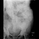 Ileus, small bowel, adhesions, follow-through: RF - Fluoroscopy