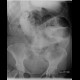 Ileus, small bowel, adhesions, follow-through: RF - Fluoroscopy