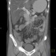 Thrombosis of superior mesenteric vein, infarsation of small bowel: CT - Computed tomography