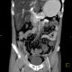 Thrombosis of superior mesenteric vein, infarsation of small bowel: CT - Computed tomography