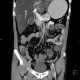 Thrombosis of superior mesenteric vein, infarsation of small bowel: CT - Computed tomography