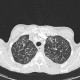 Interstitial edema of the lung: CT - Computed tomography