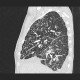 Interstitial edema of the lung: CT - Computed tomography