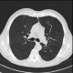 Pneumocystis carinii, pneumocystic pneumonia, follow-up, resolution: CT - Computed tomography
