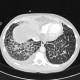 ARDS, interstitial edema: CT - Computed tomography