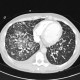 ARDS, interstitial edema: CT - Computed tomography