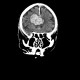 Intracerebral hemorrhage, semioval center: CT - Computed tomography