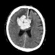 Intracerebral hemorrhage, semioval center: CT - Computed tomography