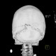 Intraparietal suture, accessory suture: CT - Computed tomography