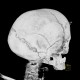 Intraparietal suture, accessory suture: CT - Computed tomography