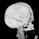 Intraparietal suture, accessory suture: CT - Computed tomography