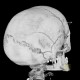 Intraparietal suture, accessory suture: CT - Computed tomography
