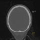 Intraparietal suture, accessory suture: CT - Computed tomography