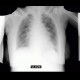 Calcification in lymph nodes in axilla, malposition of endotracheal tube, interstitial pulmonary edema: X-ray - Plain radiograph