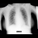 Calcification in lymph nodes in axilla, correction of endotracheal tube, disappearance of interstitial pulmonary edema - follow-up: X-ray - Plain radiograph