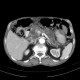 Intrapapillary mucinous neoplasm of pancreas, IPMN, IPMT, main duct type: CT - Computed tomography