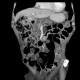 Intrapapillary mucinous neoplasm of pancreas, IPMN, IPMT, main duct type: CT - Computed tomography