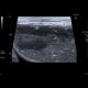 Ileus, small bowel obstruction, SBO: US - Ultrasound