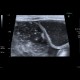 Ileus, small bowel obstruction, SBO: US - Ultrasound