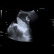 Ileus, small bowel obstruction, SBO: US - Ultrasound