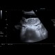 Ileus, small bowel obstruction, SBO: US - Ultrasound