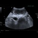 Ileus, small bowel obstruction, SBO: US - Ultrasound