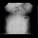 Crohn's disease, small bowel obstruction, ileus: X-ray - Plain radiograph
