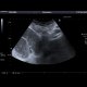 Small bowel ileus: US - Ultrasound