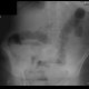 Small bowel ileus: X-ray - Plain radiograph