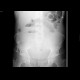 Ileus, small bowel: X-ray - Plain radiograph