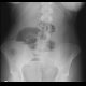 Small bowel ileus: X-ray - Plain radiograph