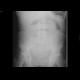 Ileus, small bowel: X-ray - Plain radiograph