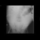 Ileus, small bowel: X-ray - Plain radiograph