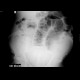 Ileus, large bowel: X-ray - Plain radiograph