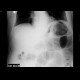 Ileus, large bowel: X-ray - Plain radiograph