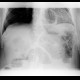 Small bowel ileus: X-ray - Plain radiograph