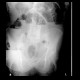 Small bowel ileus: X-ray - Plain radiograph