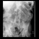 Small bowel ileus: RF - Fluoroscopy