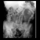 Small bowel ileus: RF - Fluoroscopy