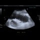 Ileus, small bowel: US - Ultrasound