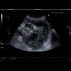 Ileus: US - Ultrasound