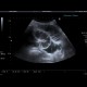 Ileus: US - Ultrasound