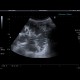 Ileus: US - Ultrasound