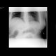 Small bowel ileus: X-ray - Plain radiograph