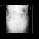 Small bowel ileus: X-ray - Plain radiograph