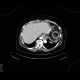 Constipation, large bowel obstruction, low grade: CT - Computed tomography