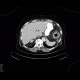 Constipation, large bowel obstruction, low grade: CT - Computed tomography