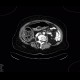 Constipation, large bowel obstruction, low grade: CT - Computed tomography