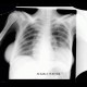 Breast implants on chest radiograph: X-ray - Plain radiograph