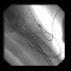 Shunt stenosis, angioplasty: AG - Angiography